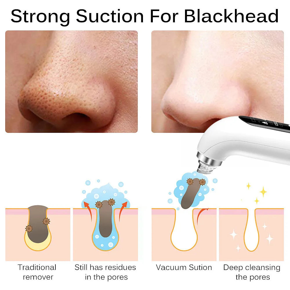 Blackhead Pore Remover